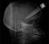 Xray shank head